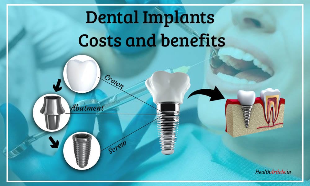 Dental Implants Cost Gnews Mail